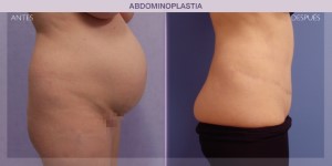 Before and after image of a tummy tuck procedure.